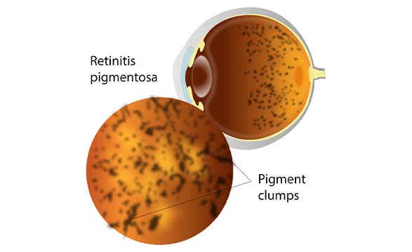 Retinitis Pigment